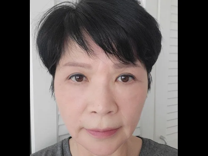 Sub-brow Lift, Lower Blepharoplasty (Aging Eye Rejuvenation) — RE&RE PLASTIC SURGERY 4