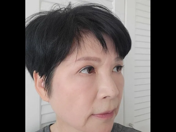 Sub-brow Lift, Lower Blepharoplasty (Aging Eye Rejuvenation) — RE&RE PLASTIC SURGERY 5