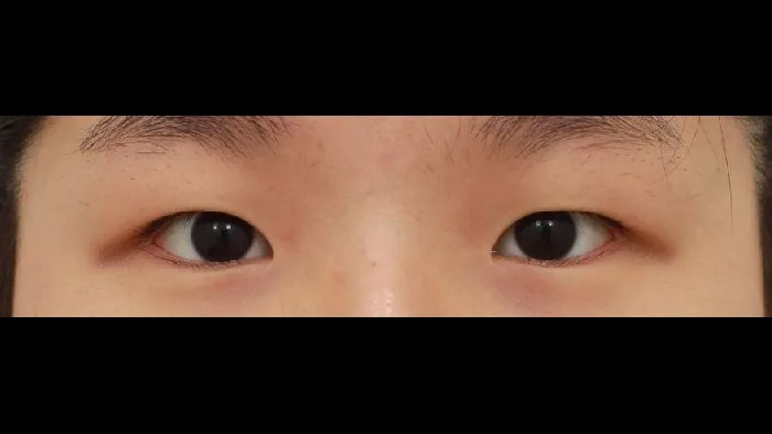 Incisional Double Eyelid Surgery, Ptosis Correction — RE&RE PLASTIC SURGERY 1