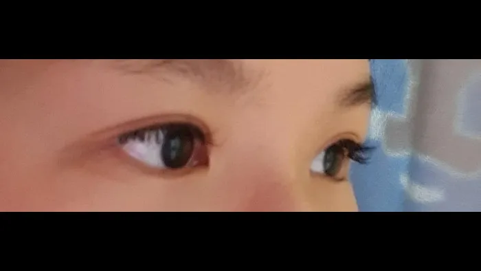 Incisional Double Eyelid Surgery, Ptosis Correction — RE&RE PLASTIC SURGERY 2