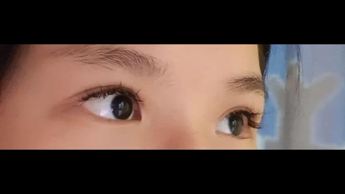 Incisional Double Eyelid Surgery, Ptosis Correction — RE&RE PLASTIC SURGERY 3