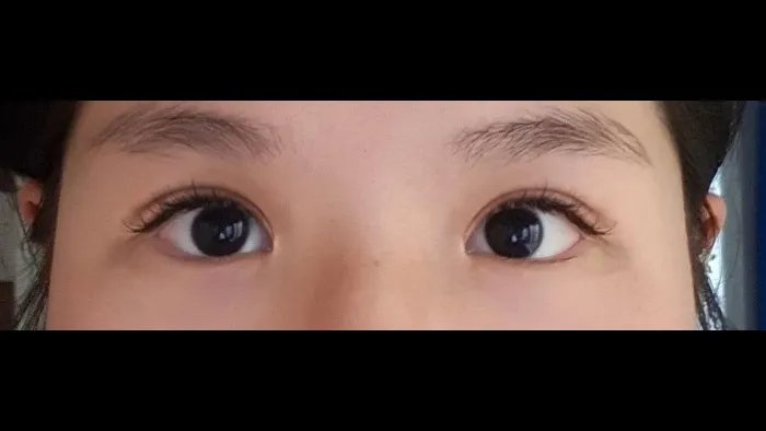 Incisional Double Eyelid Surgery, Ptosis Correction — RE&RE PLASTIC SURGERY 4