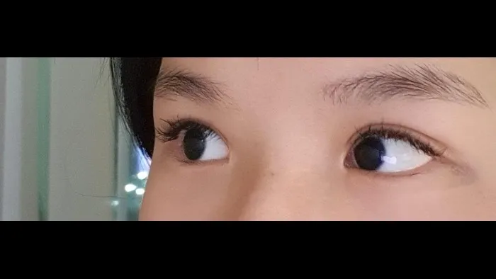 Incisional Double Eyelid Surgery, Ptosis Correction — RE&RE PLASTIC SURGERY 5