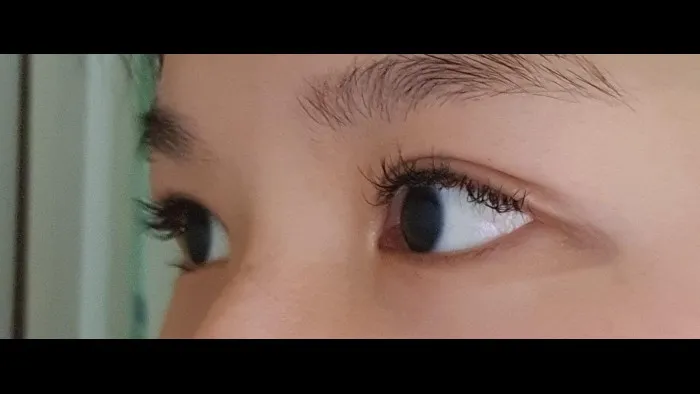 Incisional Double Eyelid Surgery, Ptosis Correction — RE&RE PLASTIC SURGERY 6