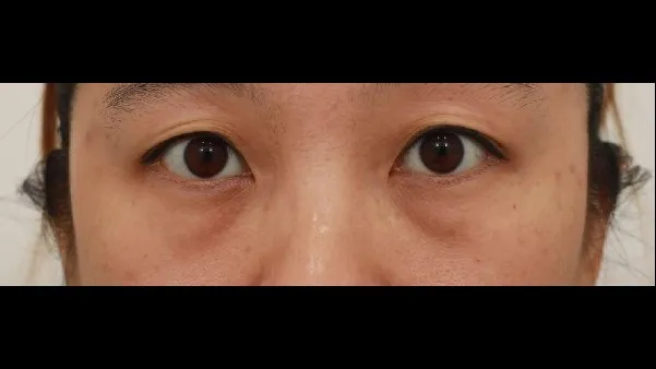 Lower Blepharoplasty (Aging Eye Rejuvenation), Lower Eyelid Fat Grafting, Midface Lift — RE&RE PLASTIC SURGERY 2