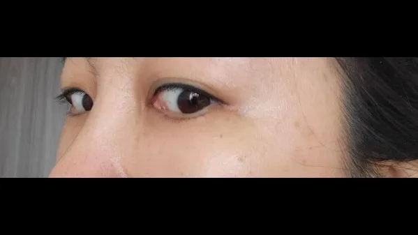 Lower Blepharoplasty (Aging Eye Rejuvenation), Lower Eyelid Fat Grafting, Midface Lift — RE&RE PLASTIC SURGERY 3