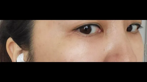Lower Blepharoplasty (Aging Eye Rejuvenation), Lower Eyelid Fat Grafting, Midface Lift — RE&RE PLASTIC SURGERY 5
