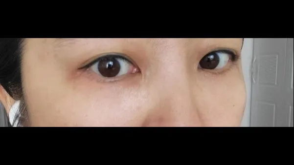 Lower Blepharoplasty (Aging Eye Rejuvenation), Lower Eyelid Fat Grafting, Midface Lift — RE&RE PLASTIC SURGERY 6