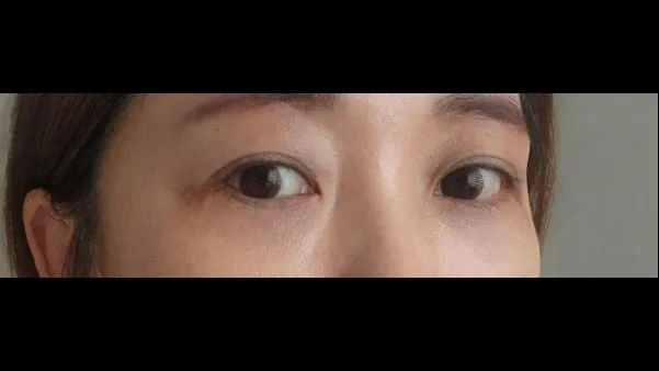 Lower Blepharoplasty (Aging Eye Rejuvenation), Lower Eyelid Fat Grafting — RE&RE PLASTIC SURGERY 2