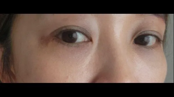 Lower Blepharoplasty (Aging Eye Rejuvenation), Lower Eyelid Fat Grafting — RE&RE PLASTIC SURGERY 3