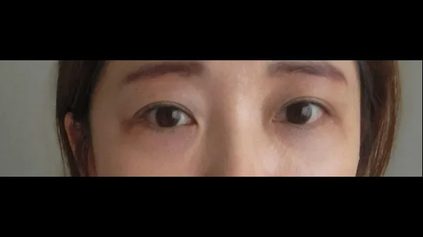 Lower Blepharoplasty (Aging Eye Rejuvenation), Lower Eyelid Fat Grafting — RE&RE PLASTIC SURGERY 4