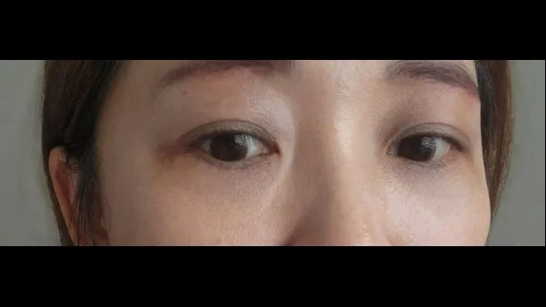 Lower Blepharoplasty (Aging Eye Rejuvenation), Lower Eyelid Fat Grafting — RE&RE PLASTIC SURGERY 5