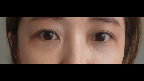 Lower Blepharoplasty (Aging Eye Rejuvenation), Lower Eyelid Fat Grafting — RE&RE PLASTIC SURGERY 6