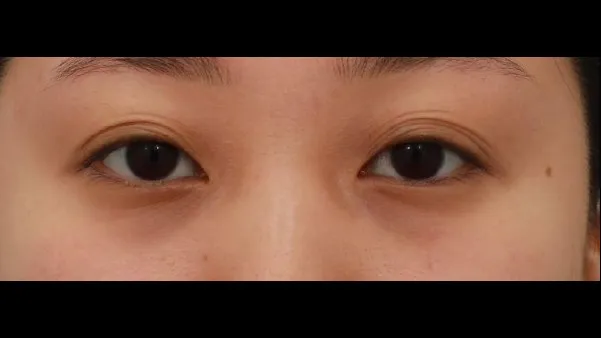 Ptosis Correction, Incisional Double Eyelid Surgery, Lower Eyelid Fat Grafting 1