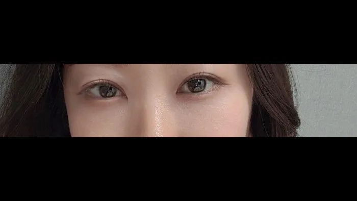 Ptosis Correction, Incisional Double Eyelid Surgery, Lower Eyelid Fat Grafting — RE&RE PLASTIC SURGERY 2