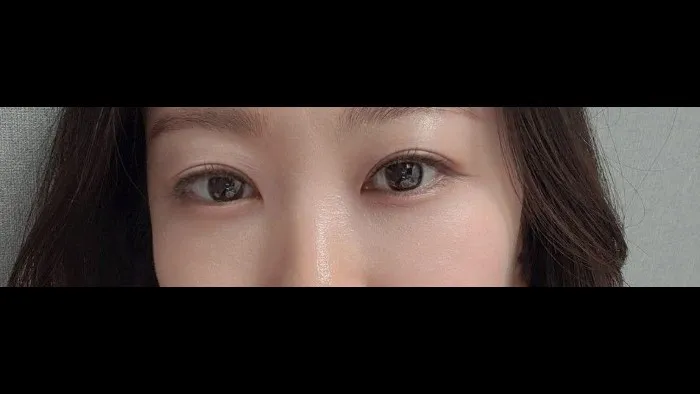 Ptosis Correction, Incisional Double Eyelid Surgery, Lower Eyelid Fat Grafting — RE&RE PLASTIC SURGERY 3