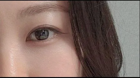 Ptosis Correction, Incisional Double Eyelid Surgery, Lower Eyelid Fat Grafting — RE&RE PLASTIC SURGERY 4