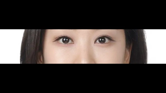 Ptosis Correction, Incisional Double Eyelid Surgery, Lower Eyelid Fat Grafting — RE&RE PLASTIC SURGERY 5
