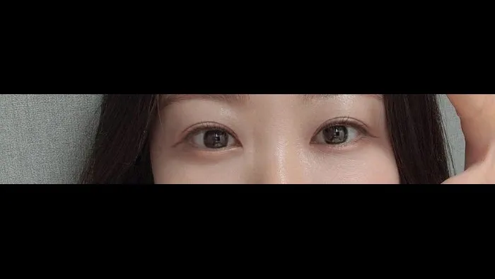 Ptosis Correction, Incisional Double Eyelid Surgery, Lower Eyelid Fat Grafting — RE&RE PLASTIC SURGERY 6