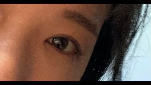 Incisional Double Eyelid Surgery, Ptosis Correction — RE&RE PLASTIC SURGERY 2