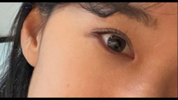 Incisional Double Eyelid Surgery, Ptosis Correction — RE&RE PLASTIC SURGERY 3