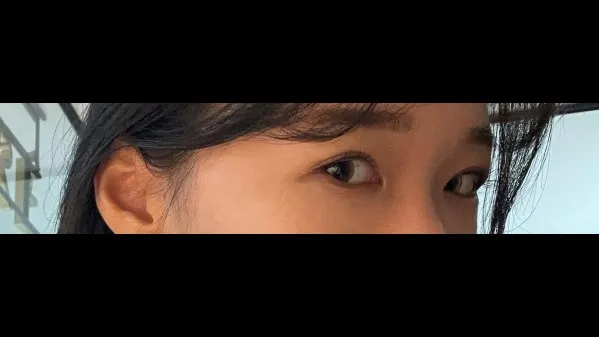 Incisional Double Eyelid Surgery, Ptosis Correction — RE&RE PLASTIC SURGERY 4