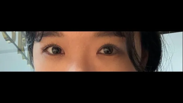 Incisional Double Eyelid Surgery, Ptosis Correction — RE&RE PLASTIC SURGERY 5