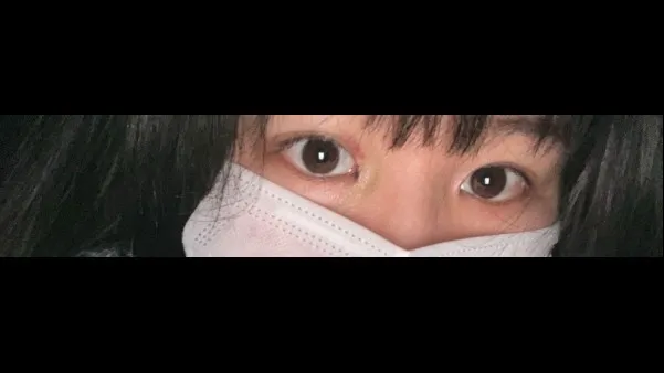 Natural Adhesion Double Eyelid Surgery, Ptosis Correction — RE&RE PLASTIC SURGERY 2