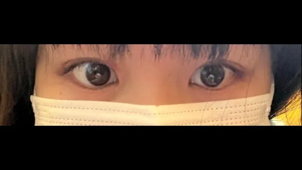 Natural Adhesion Double Eyelid Surgery, Ptosis Correction — RE&RE PLASTIC SURGERY 3