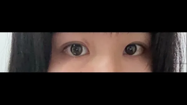 Natural Adhesion Double Eyelid Surgery, Ptosis Correction — RE&RE PLASTIC SURGERY 4