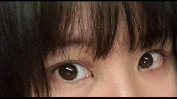 Natural Adhesion Double Eyelid Surgery, Ptosis Correction — RE&RE PLASTIC SURGERY 5