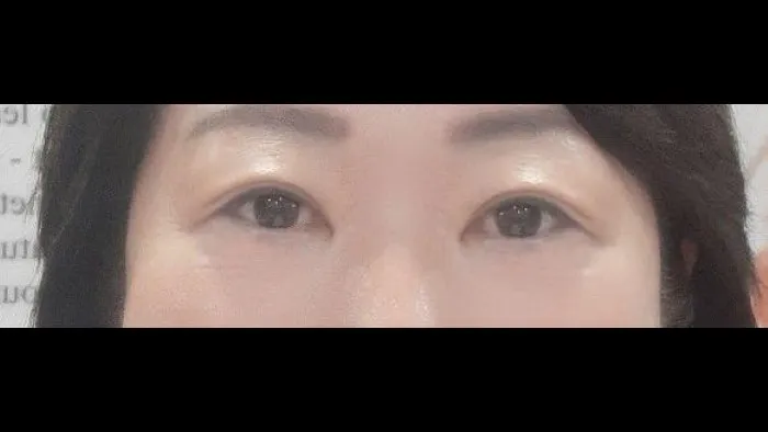 Sub-brow Lift — RE&RE PLASTIC SURGERY 2