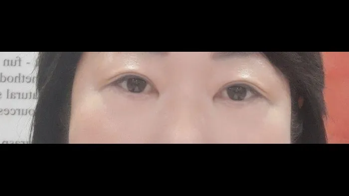 Sub-brow Lift — RE&RE PLASTIC SURGERY 5
