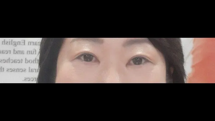 Sub-brow Lift — RE&RE PLASTIC SURGERY 6