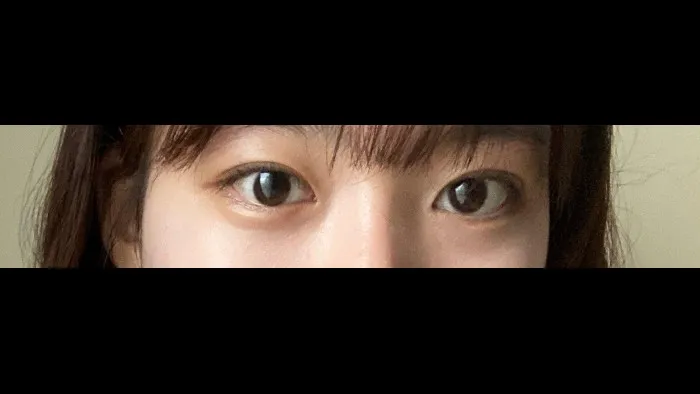 Incisional Double Eyelid Surgery — RE&RE PLASTIC SURGERY 2