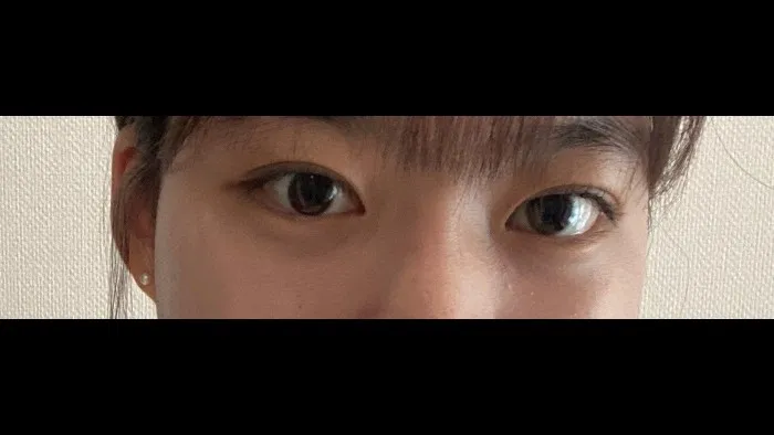 Incisional Double Eyelid Surgery — RE&RE PLASTIC SURGERY 3