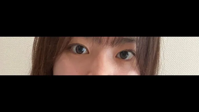 Incisional Double Eyelid Surgery — RE&RE PLASTIC SURGERY 4