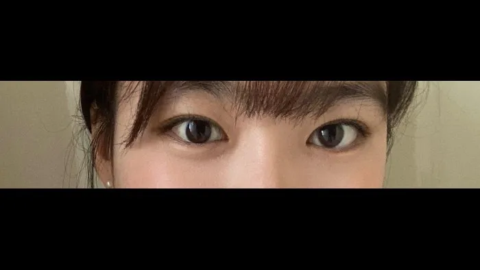 Incisional Double Eyelid Surgery — RE&RE PLASTIC SURGERY 5