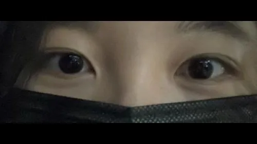 Natural Adhesion Double Eyelid Surgery, Ptosis Correction — RE&RE PLASTIC SURGERY 2