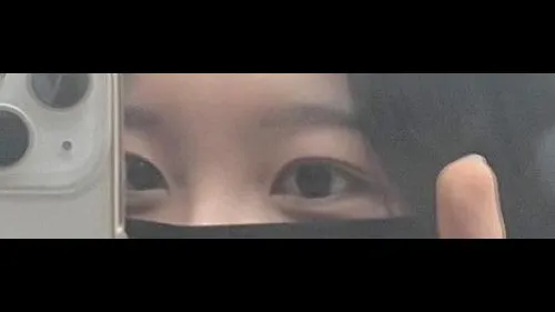 Natural Adhesion Double Eyelid Surgery, Ptosis Correction — RE&RE PLASTIC SURGERY 5