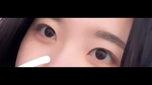 Natural Adhesion Double Eyelid Surgery, Ptosis Correction — RE&RE PLASTIC SURGERY 6