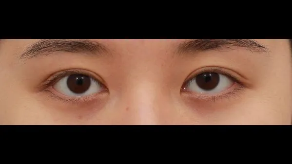 Crease lowering 1