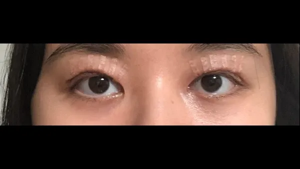 Crease lowering — RE&RE PLASTIC SURGERY 2