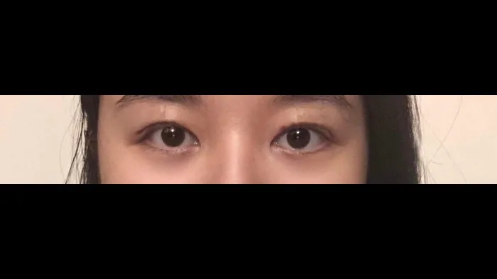 Crease lowering — RE&RE PLASTIC SURGERY 3