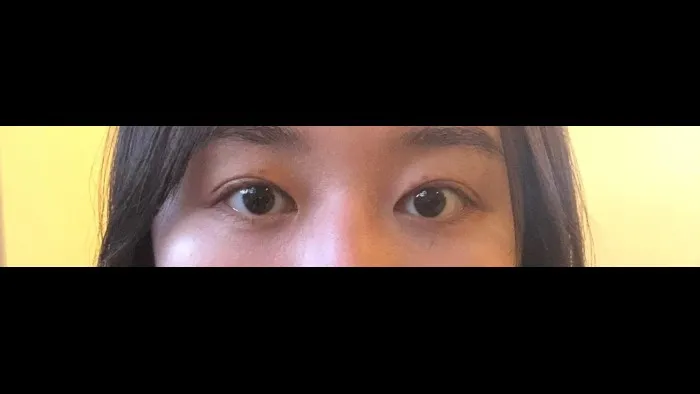 Crease lowering — RE&RE PLASTIC SURGERY 4