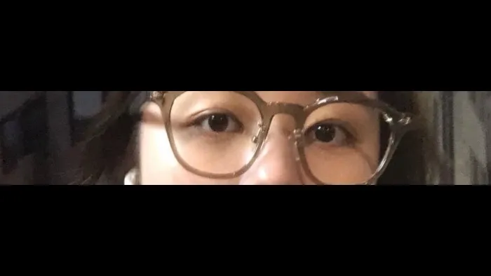 Crease lowering — RE&RE PLASTIC SURGERY 5
