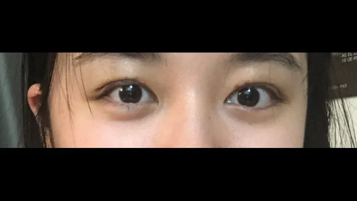 Crease lowering — RE&RE PLASTIC SURGERY 6