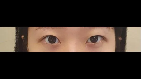 切开法(双眼皮) 1