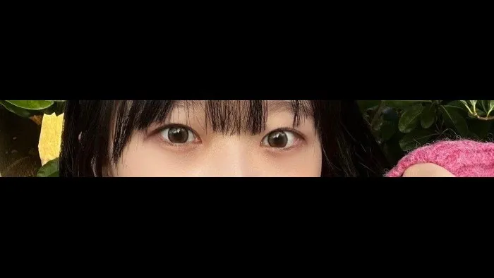 切开法（双眼皮） — RE&RE PLASTIC SURGERY 3
