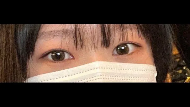 切开法（双眼皮） — RE&RE PLASTIC SURGERY 4
